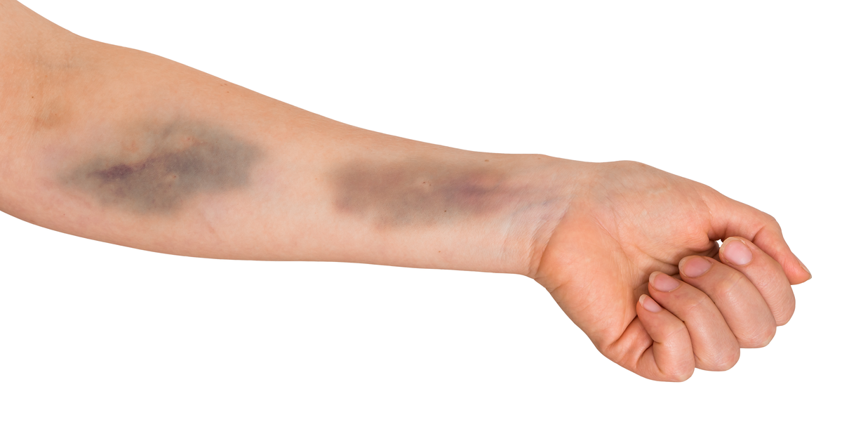 تفسير رؤية كدمات زرقاء في المنام للعزباء لابن سيرين